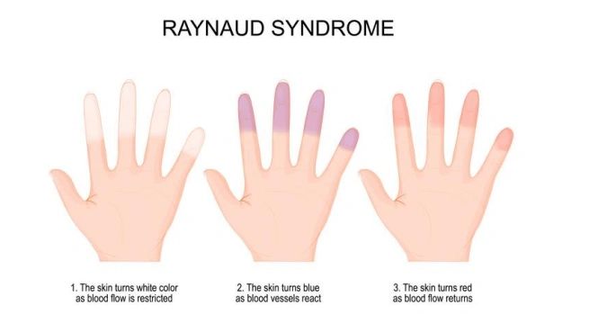 RAYNAUD'S DISEASE